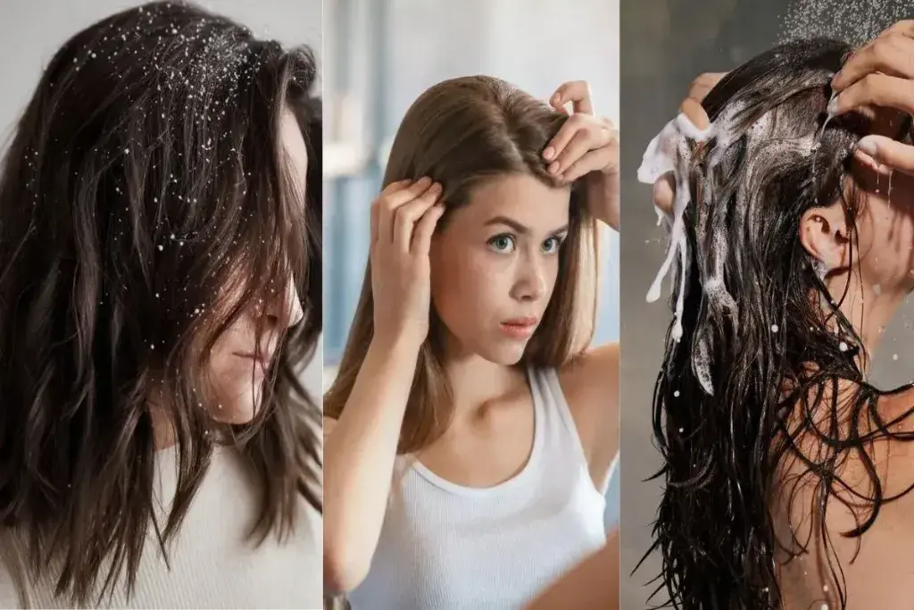 Which Anti Dandruff Shampoos Are Perfect For Itchy And Flaky Scalp?